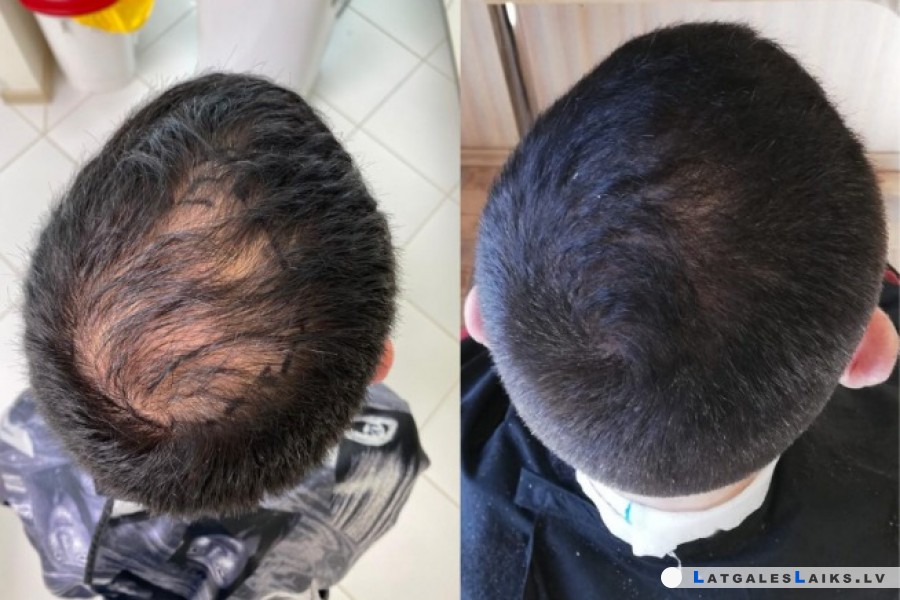 Matu izkrišanas un biezuma atjaunošana matu klīnikā Rubenhair